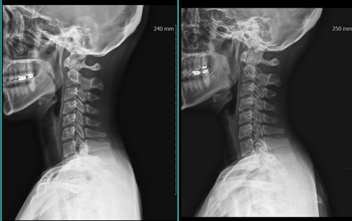 도수비포에프터